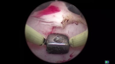 Биполярная энуклеация гиперплазии простаты